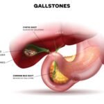 Symptoms of Gallstones