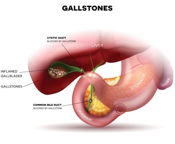 Symptoms of Gallstones